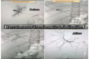 transarterial-embolization-of-pseudoaneurysm