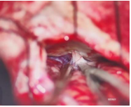 trigeminal-neuralgia-a-suicidal-disease