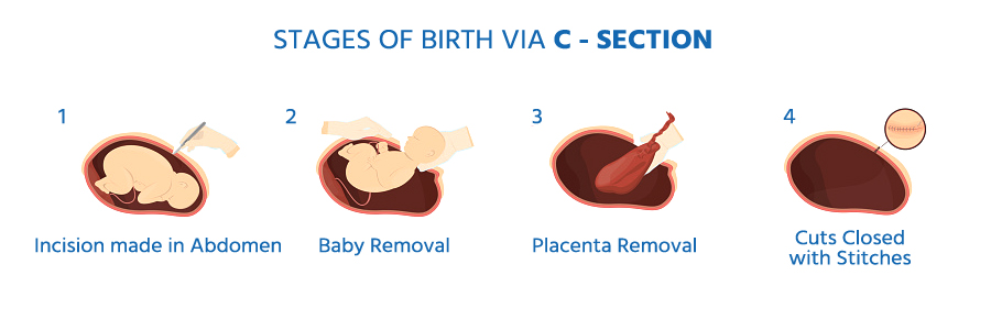 Stages of Birth Via C-Section