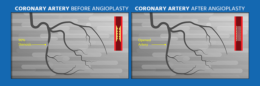 coronary angiography