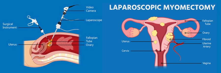 laparoscopic-myomectomy-cost
