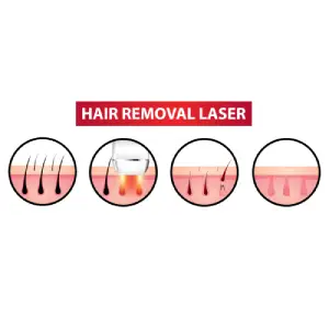 Laser Hair Removal Cost in Hyderabad, India | Medicover