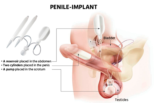 penile-implant-cost