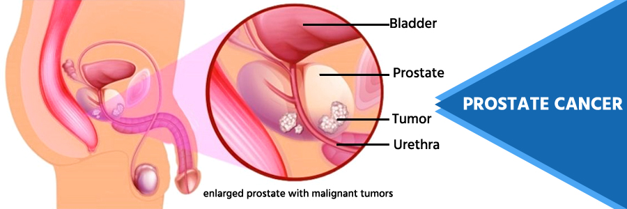 prostate-cancer-treatment