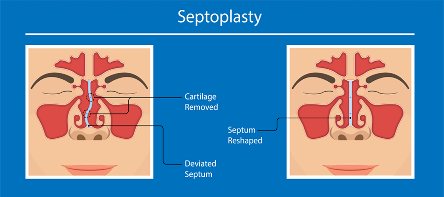 septoplasty