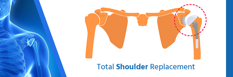 shoulder-replacement-cost