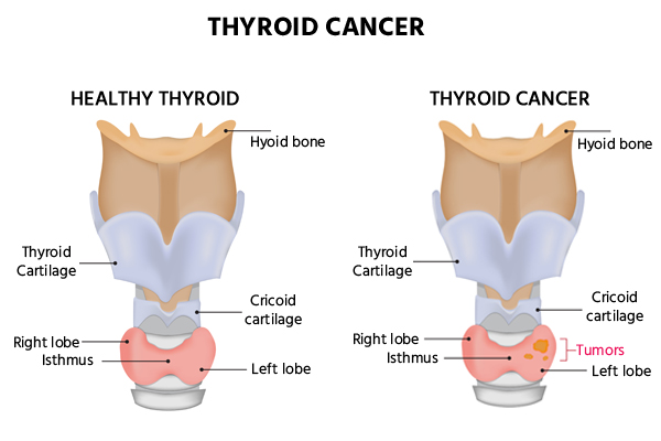 thyroid-cancer-surgery-cost