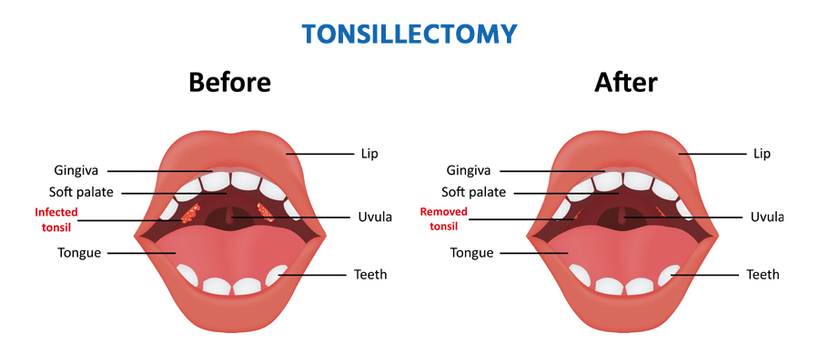 tonsillectomy