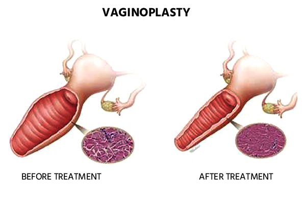 vaginoplasty-cost