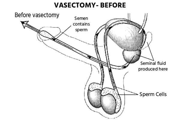 Vasectomy Reversal Before