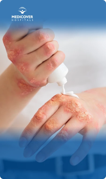 Fungal Infection Prevention Tips And Strategies