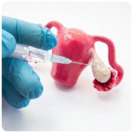 Ovulation Induction: A Fertility Treatment