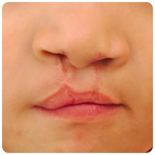 Pediatric Plastic Surgery